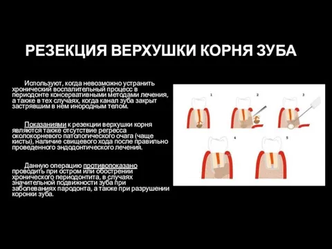 РЕЗЕКЦИЯ ВЕРХУШКИ КОРНЯ ЗУБА Используют, когда невозможно устранить хронический воспалительный процесс