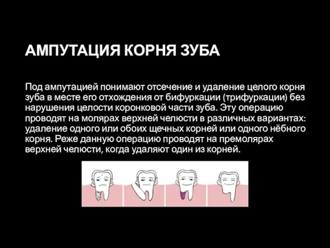 АМПУТАЦИЯ КОРНЯ ЗУБА Под ампутацией понимают отсечение и удаление целого корня