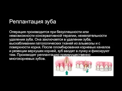 Реплантация зуба Операция производится при безуспешности или невозможности консервативной терапии, нежелательности