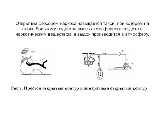 Открытым способом наркоза называется такой, при котором на вдохе больному подается