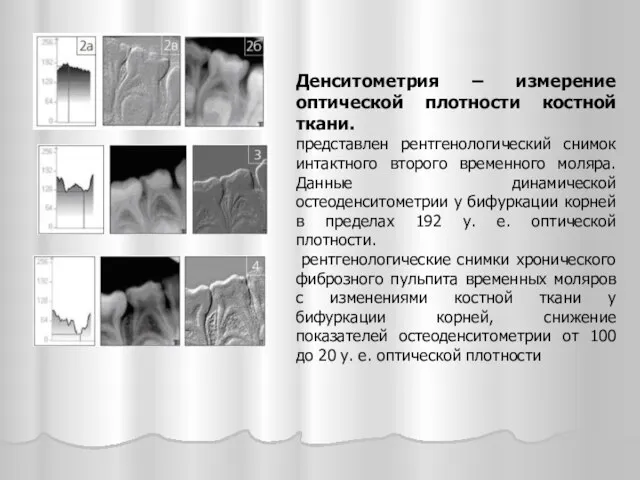 Денситометрия – измерение оптической плотности костной ткани. представлен рентгенологический снимок интактного