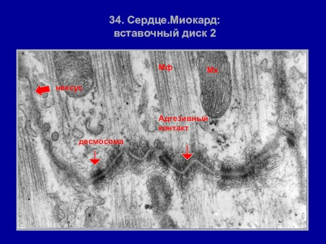 Мф Мх 34. Сердце.Миокард: вставочный диск 2 Адгезивный контакт десмосома нексус