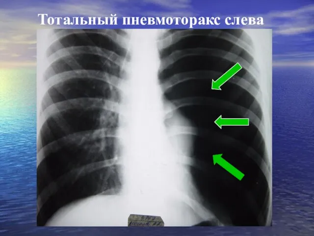 Тотальный пневмоторакс слева