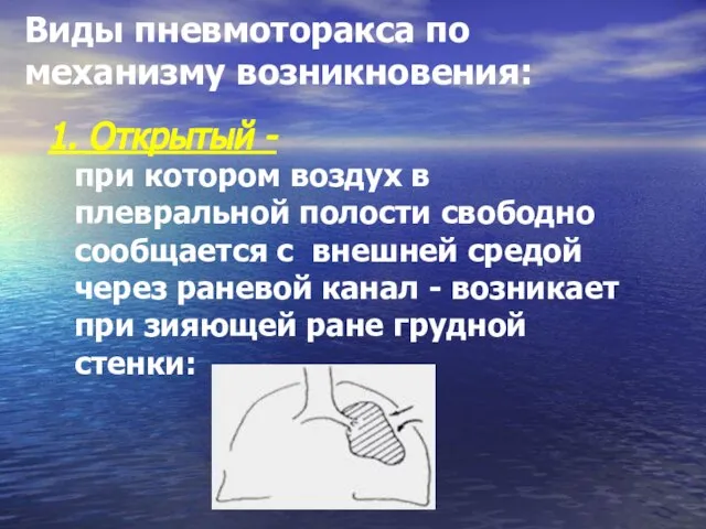 Виды пневмоторакса по механизму возникновения: при котором воздух в плевральной полости