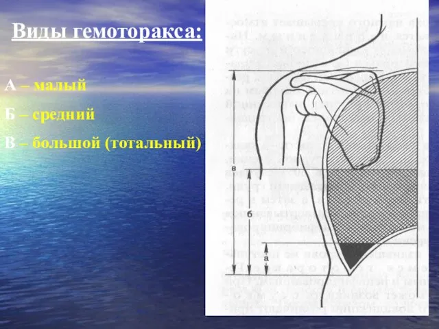 Виды гемоторакса: А – малый Б – средний В – большой (тотальный)