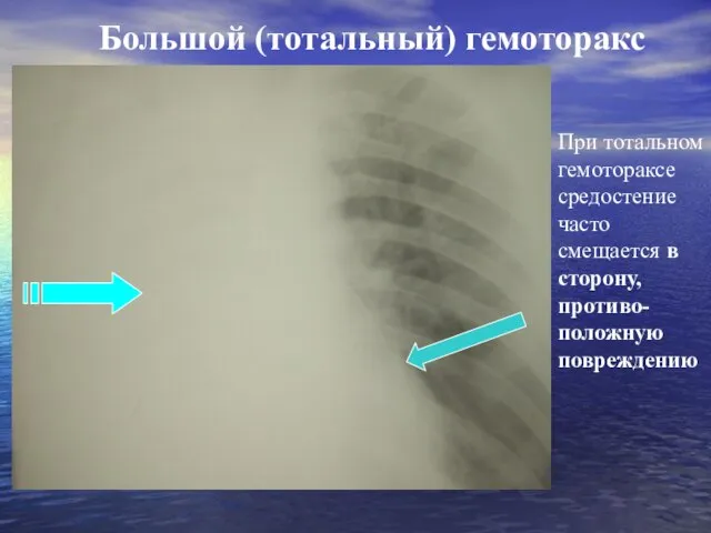 Большой (тотальный) гемоторакс При тотальном гемотораксе средостение часто смещается в сторону, противо-положную повреждению