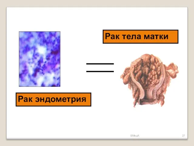 ВМедА Рак эндометрия Рак тела матки