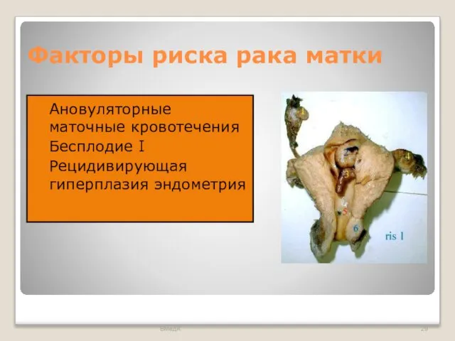 Факторы риска рака матки Ановуляторные маточные кровотечения Бесплодие I Рецидивирующая гиперплазия эндометрия ВМедА