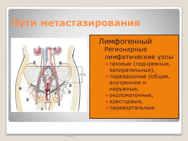 Пути метастазирования Лимфогенный Регионарные лимфатические узлы тазовые (подчревные, запирательные), подвздошные (общие,