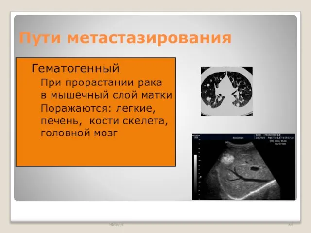 Пути метастазирования Гематогенный При прорастании рака в мышечный слой матки Поражаются: