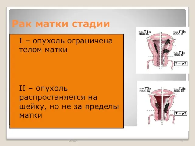 Рак матки стадии I – опухоль ограничена телом матки II –