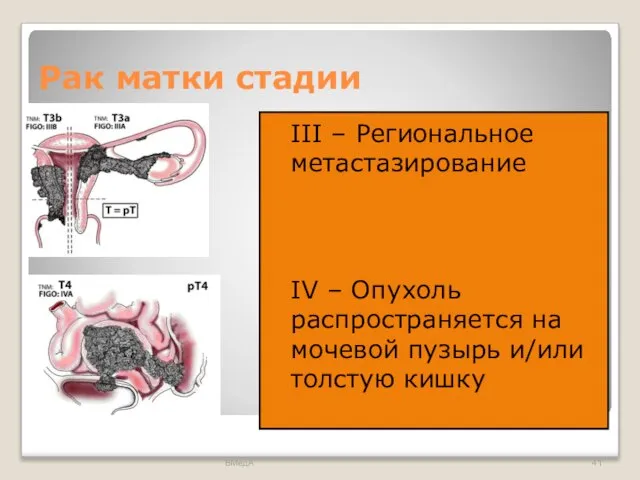 Рак матки стадии III – Региональное метастазирование IV – Опухоль распространяется