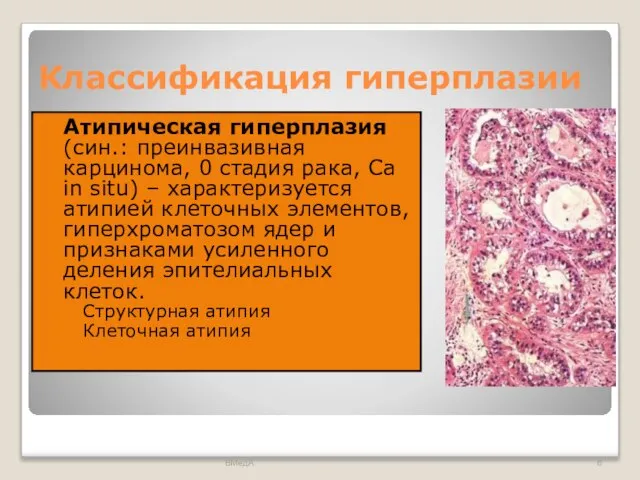 Классификация гиперплазии Атипическая гиперплазия (син.: преинвазивная карцинома, 0 стадия рака, Са