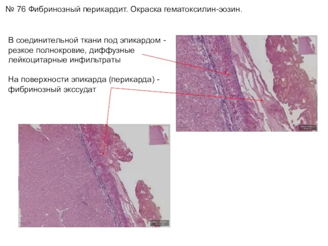 № 76 Фибринозный перикардит. Окраска гематоксилин-эозин. В соединительной ткани под эпикардом