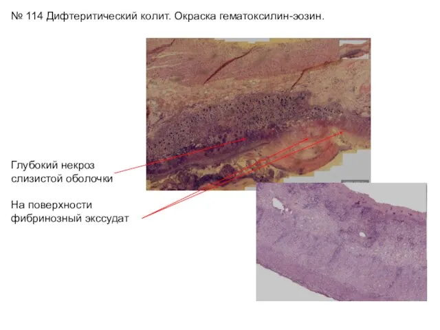 № 114 Дифтеритический колит. Окраска гематоксилин-эозин. Глубокий некроз слизистой оболочки На поверхности фибринозный экссудат