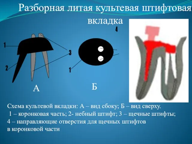 Разборная литая культевая штифтовая вкладка 4 Схема культевой вкладки: А –