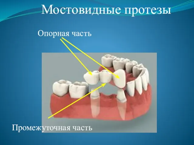 Мостовидные протезы Опорная часть Промежуточная часть