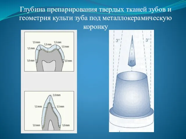 Глубина препарирования твердых тканей зубов и геометрия культи зуба под металлокерамическую коронку