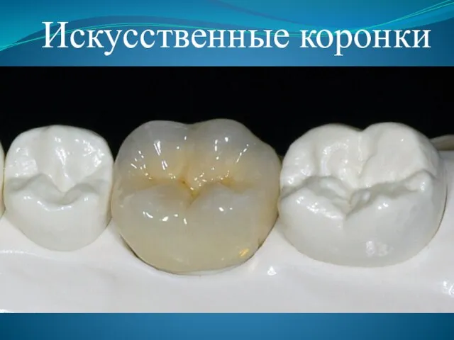 Искусственные коронки