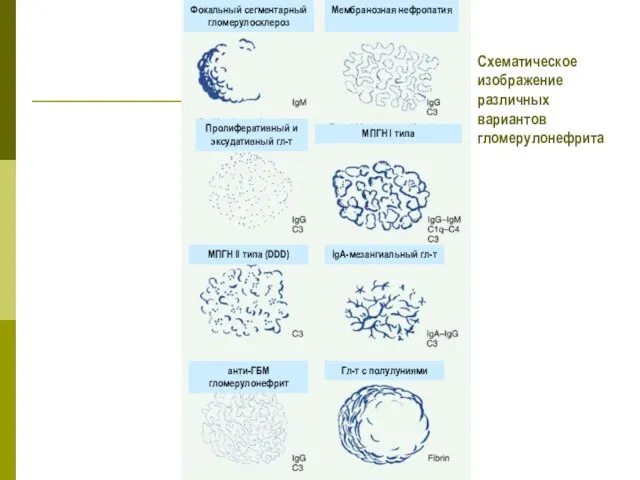 Фокальный сегментарный гломерулосклероз Мембранозная нефропатия Пролиферативный и эксудативный гл-т МПГН I