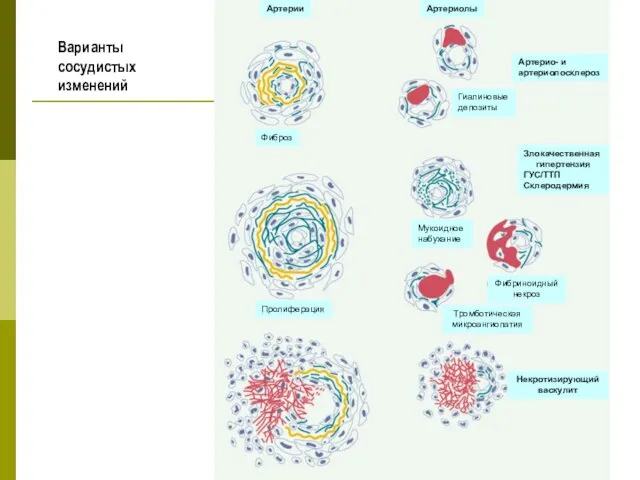 Гиалиновые депозиты Артерио- и артериолосклероз Артерии Артериолы Фиброз Пролиферация Мукоидное набухание
