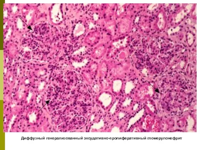 Диффузный генерализованный эксудативно-пролиферативный гломерулонефрит