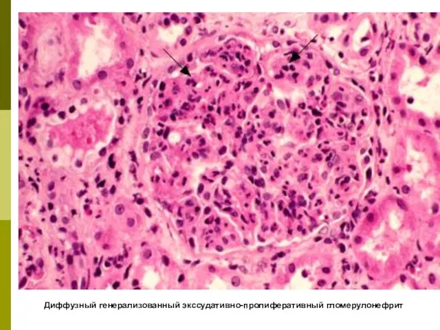 Диффузный генерализованный экссудативно-пролиферативный гломерулонефрит