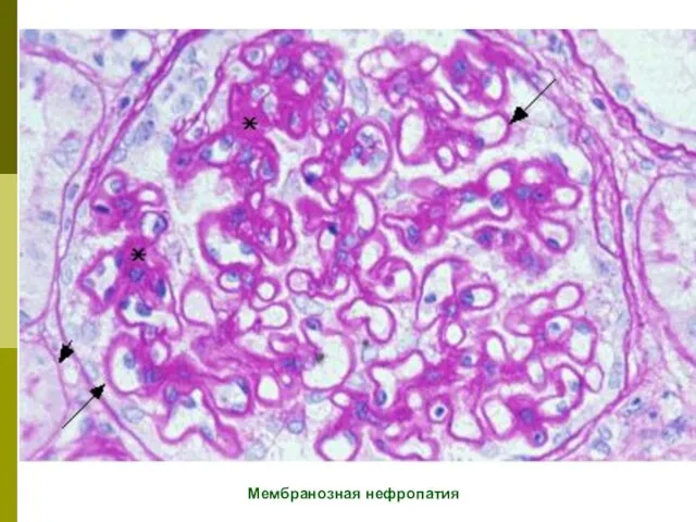Мембранозная нефропатия