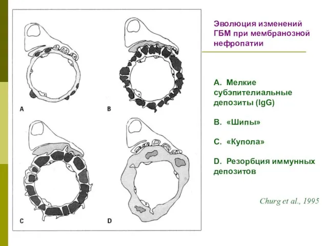 Эволюция изменений ГБМ при мембранозной нефропатии А. Мелкие субэпителиальные депозиты (IgG)