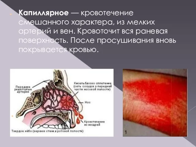 Капиллярное — кровотечение смешанного характера, из мелких артерий и вен. Кровоточит