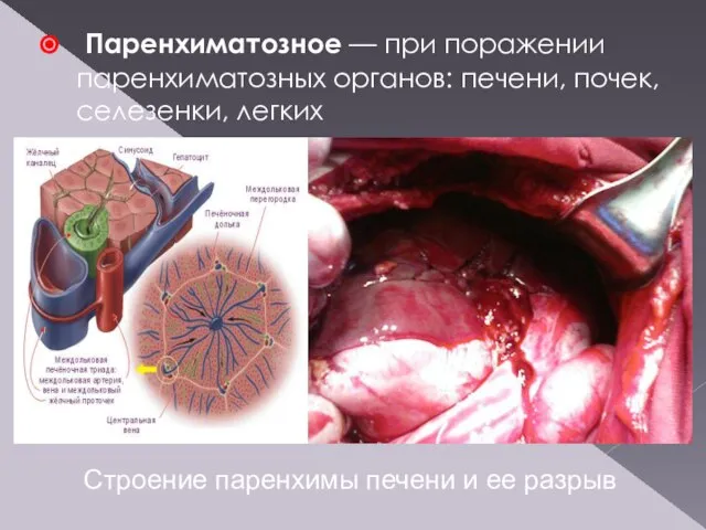 Паренхиматозное — при поражении паренхиматозных органов: печени, почек, селезенки, легких Строение паренхимы печени и ее разрыв