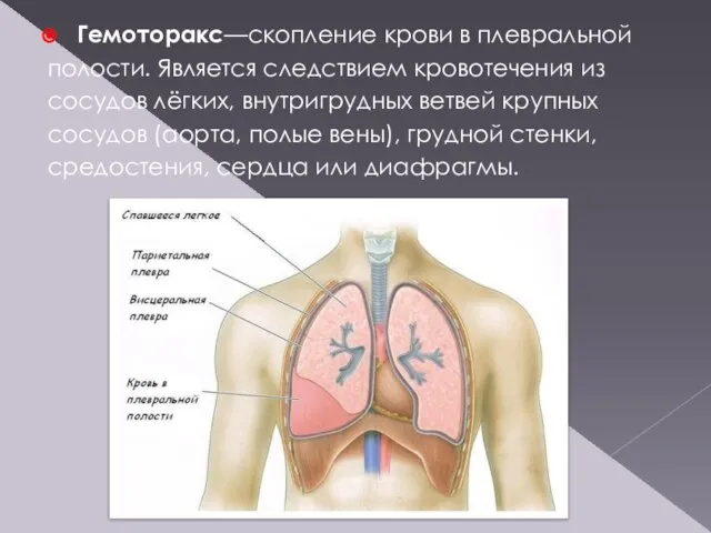 Гемоторакс—скопление крови в плевральной полости. Является следствием кровотечения из сосудов лёгких,