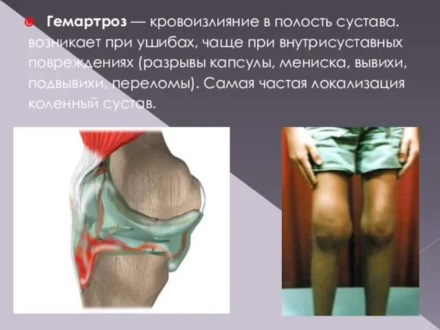 Гемартроз — кровоизлияние в полость сустава. возникает при ушибах, чаще при