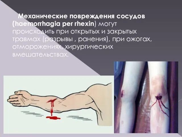 Механические повреждения сосудов (haemorrhagia per rhexin) могут происходить при открытых и