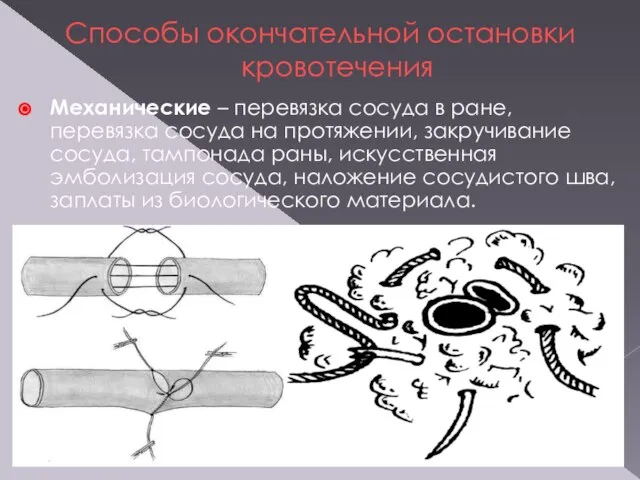 Способы окончательной остановки кровотечения Механические – перевязка сосуда в ране, перевязка