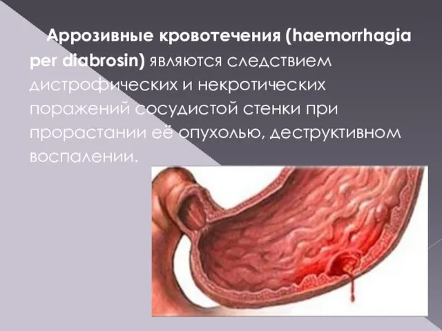 Аррозивные кровотечения (haemorrhagia per diabrosin) являются следствием дистрофических и некротических поражений