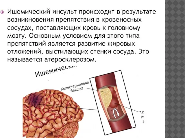 Ишемический инсульт происходит в результате возникновения препятствия в кровеносных сосудах, поставляющих