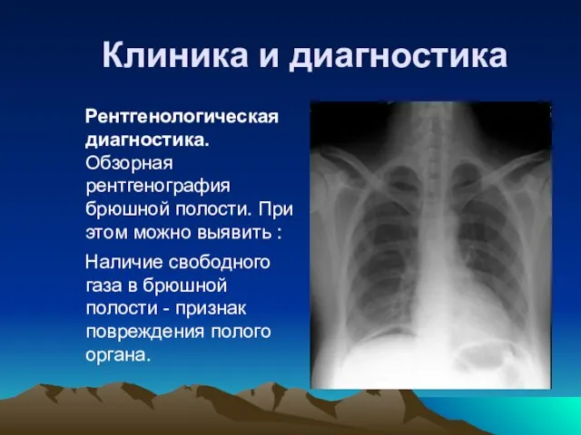 Клиника и диагностика Рентгенологическая диагностика. Обзорная рентгенография брюшной полости. При этом