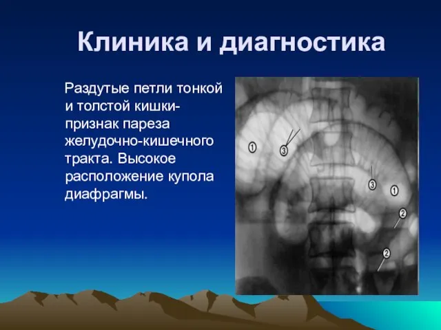 Клиника и диагностика Раздутые петли тонкой и толстой кишки- признак пареза