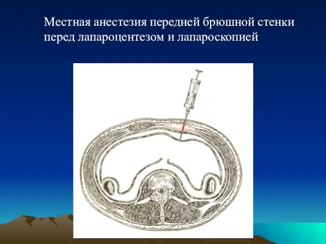 Местная анестезия передней брюшной стенки перед лапароцентезом и лапароскопией