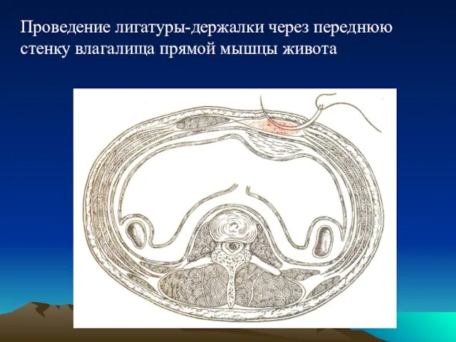 Проведение лигатуры-держалки через переднюю стенку влагалища прямой мышцы живота