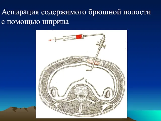 Аспирация содержимого брюшной полости с помощью шприца