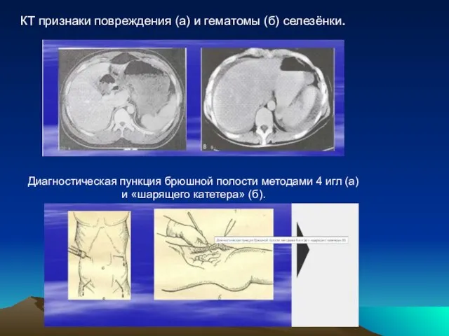 КТ признаки повреждения (а) и гематомы (б) селезёнки. Диагностическая пункция брюшной
