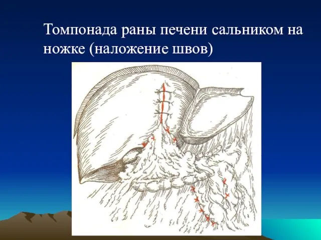 Томпонада раны печени сальником на ножке (наложение швов)