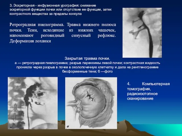 3. Эскреторная - инфузионная урография: снижение эскреторной функции почки или отсутствие