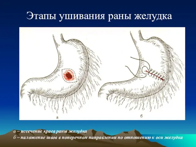 Этапы ушивания раны желудка а – иссечение краев раны желудка б