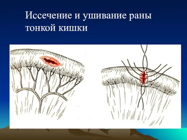 Иссечение и ушивание раны тонкой кишки