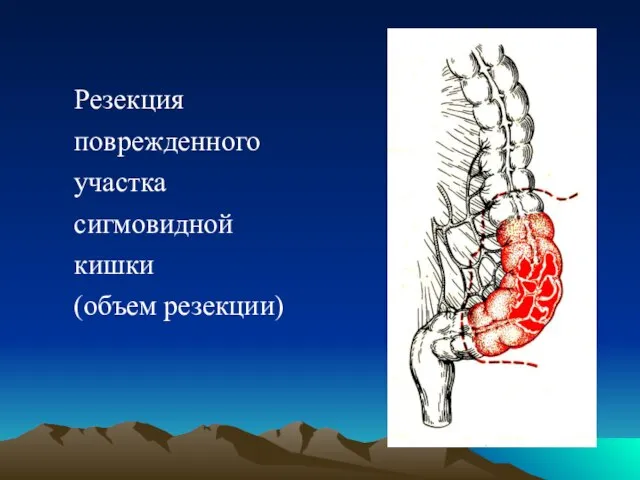 Резекция поврежденного участка сигмовидной кишки (объем резекции)