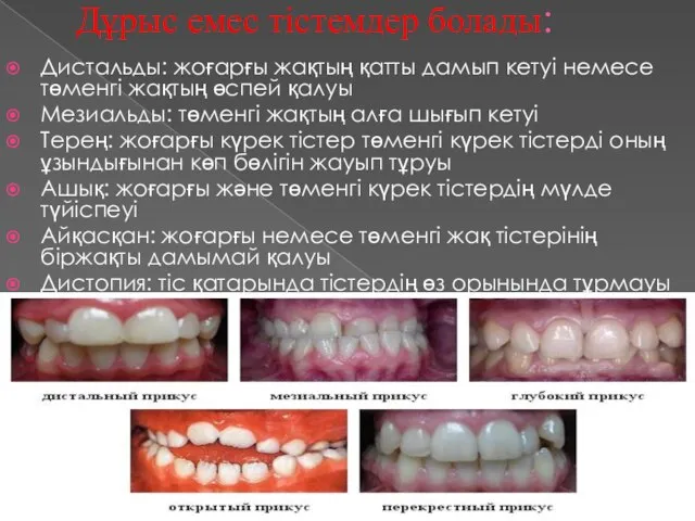 Дұрыс емес тістемдер болады: Дистальды: жоғарғы жақтың қатты дамып кетуі немесе