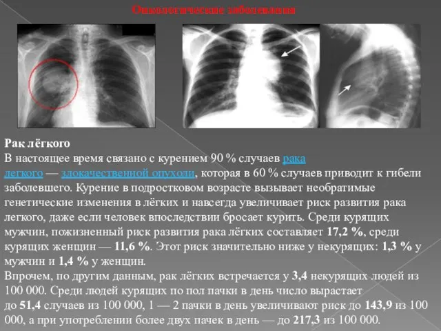 Онкологические заболевания Рак лёгкого В настоящее время связано с курением 90